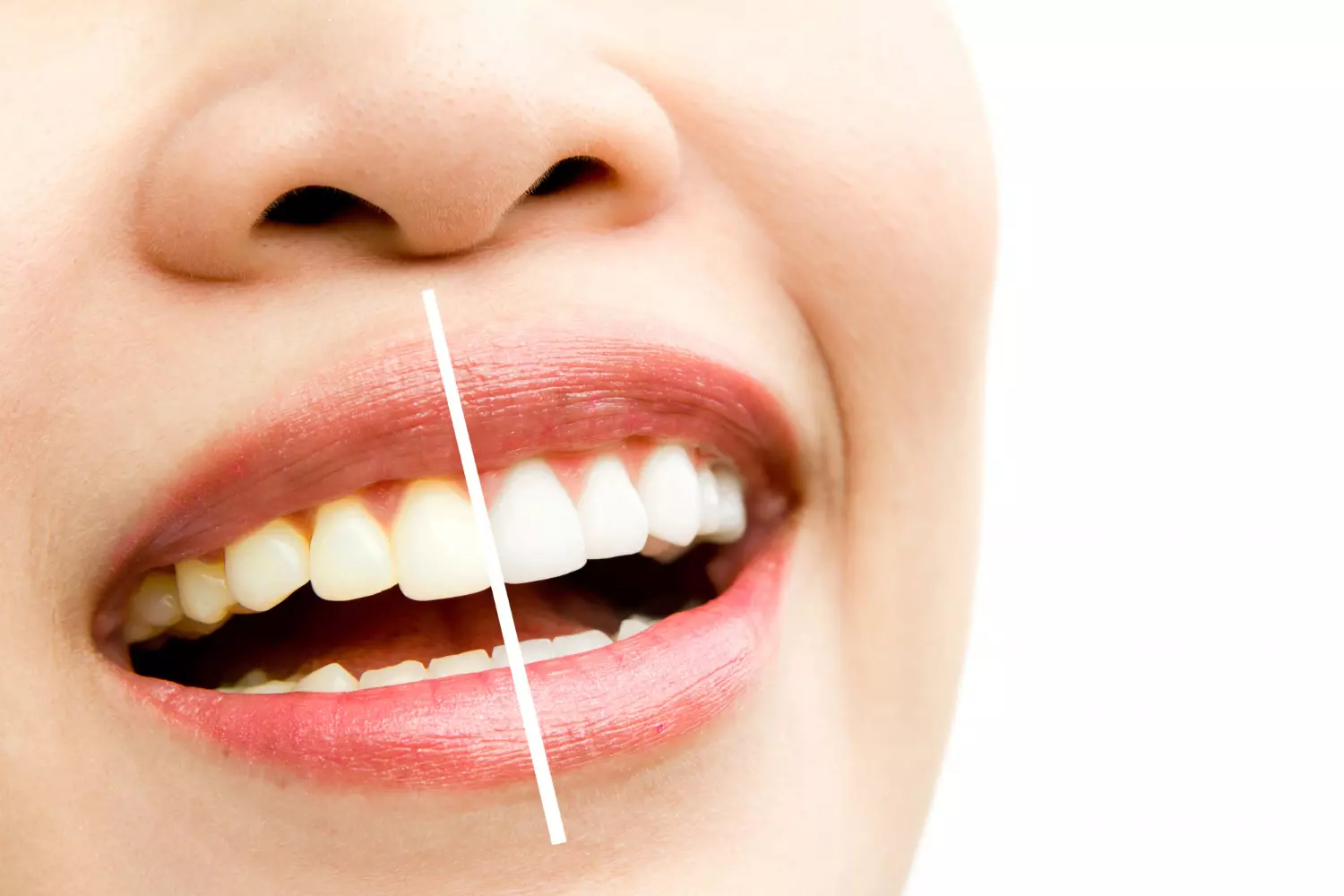 Dientes muy amarillos